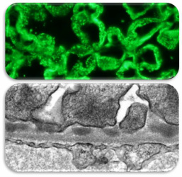 sub epithelial immune complexes, anti Fx1A