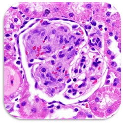 anti Thy 1 mesangioproliferative glomerulonephritis